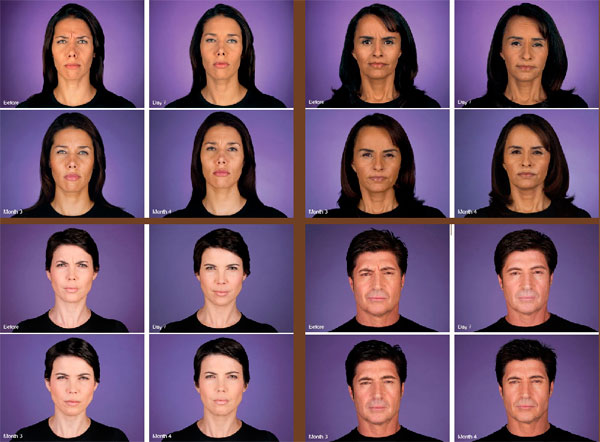 botox-image