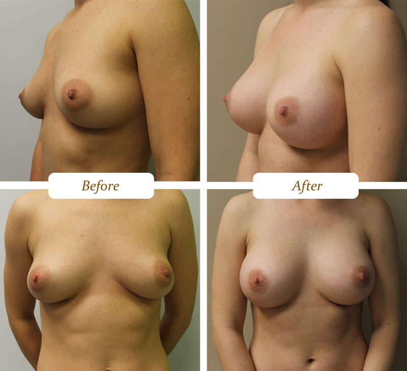 breast_aug_1