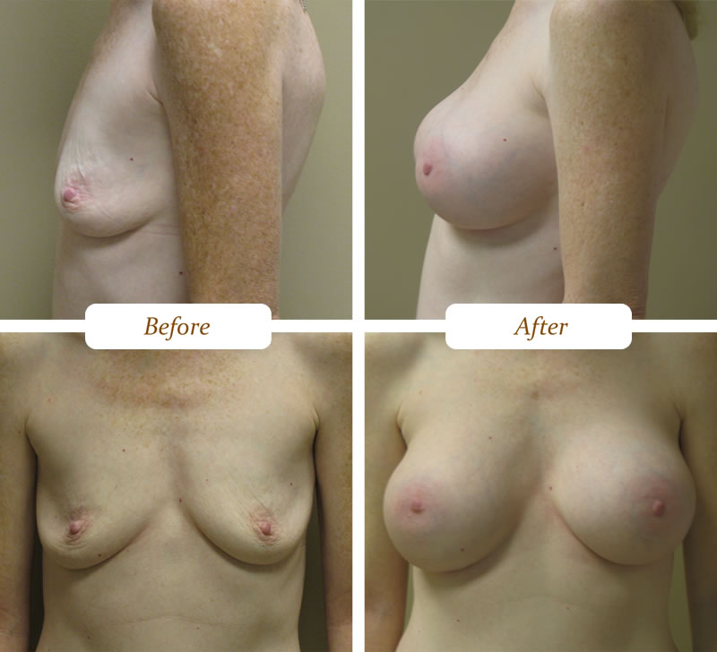 breast_aug_10
