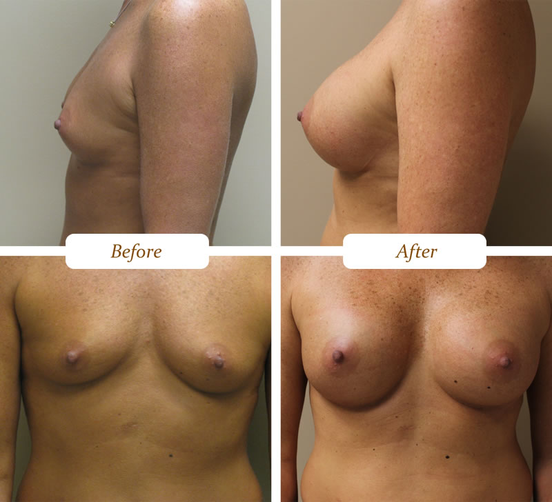 breast_aug_11