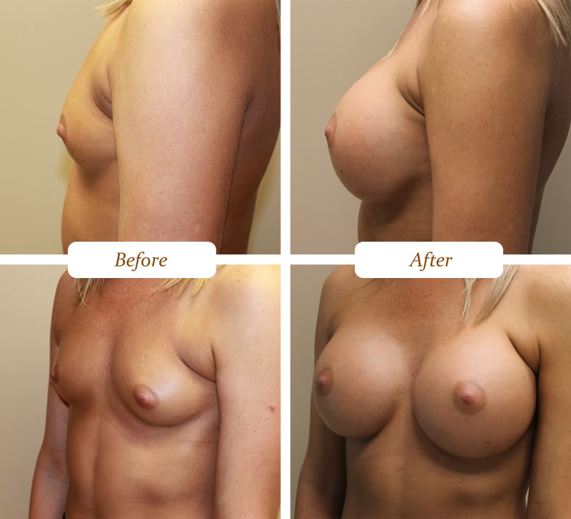 breast_aug_12
