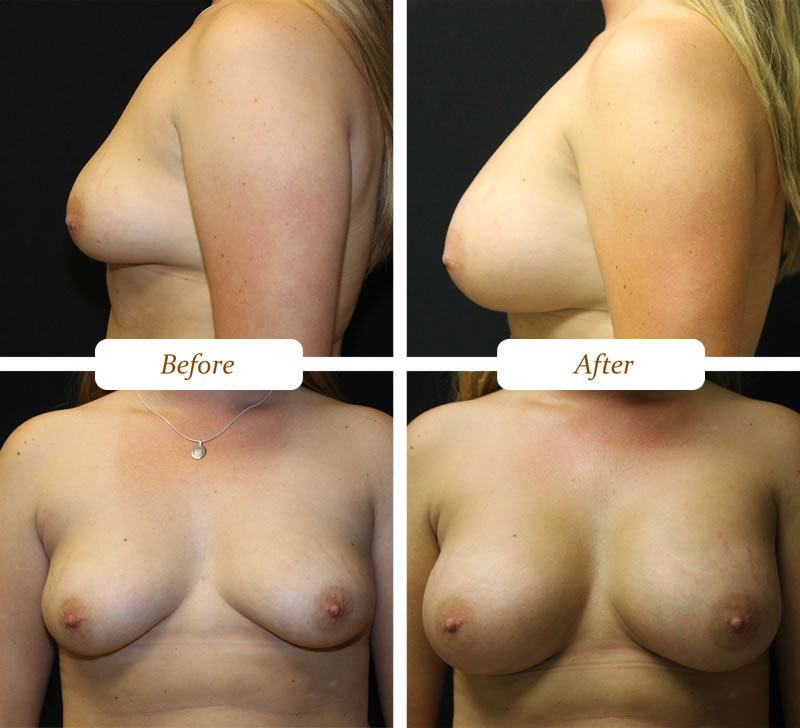 breast_aug_2