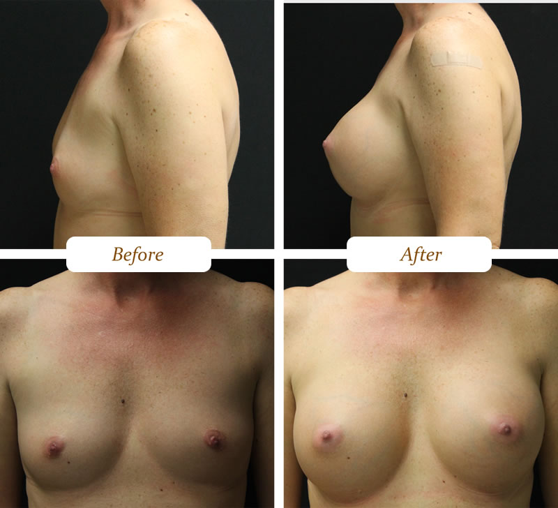 breast_aug_3