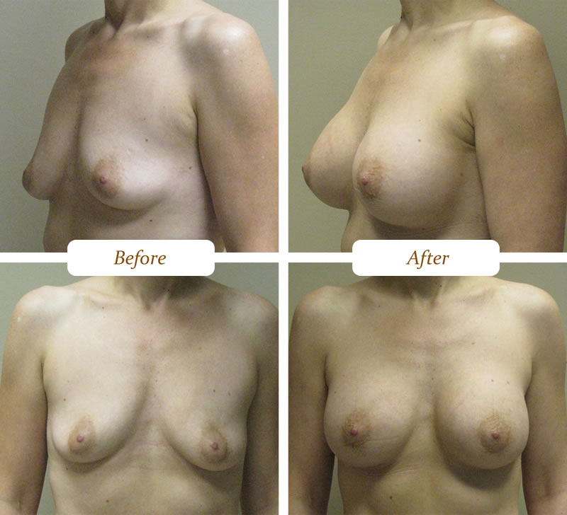 breast_aug_4