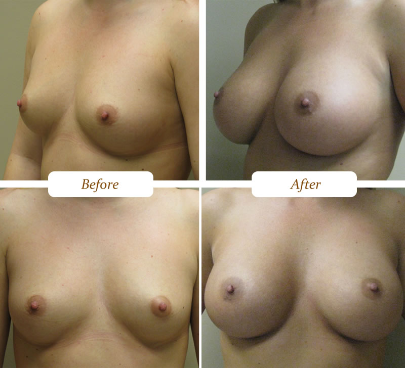 breast_aug_5