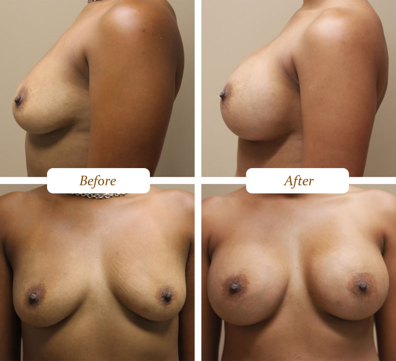 breast_aug_6