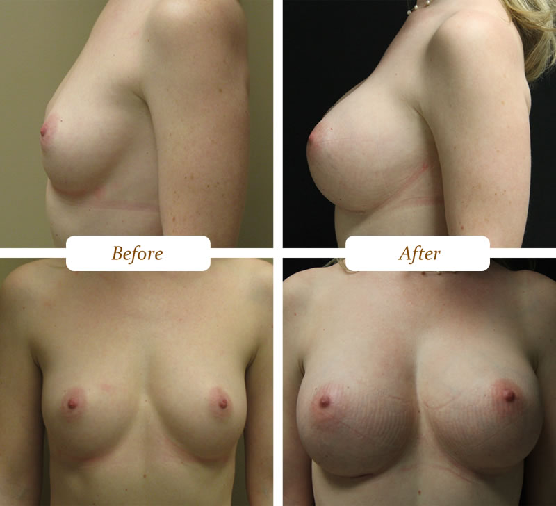 breast_aug_7