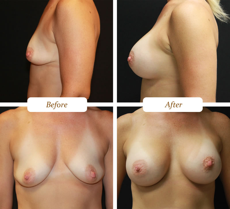 breast_aug_8