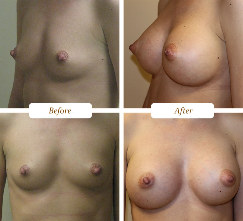 breast_aug_9