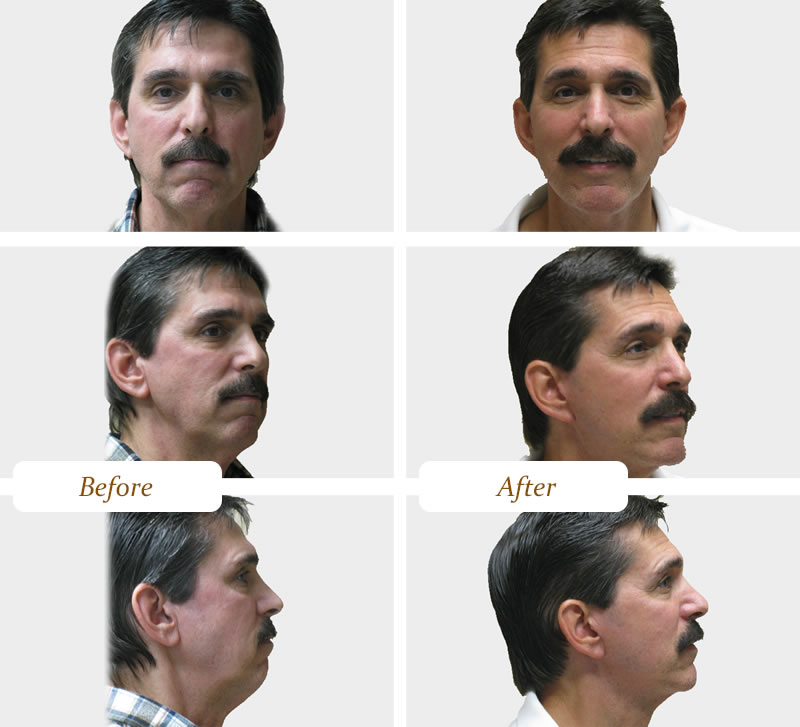 chin 1