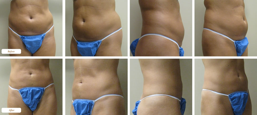 Liposuction-Surgery
