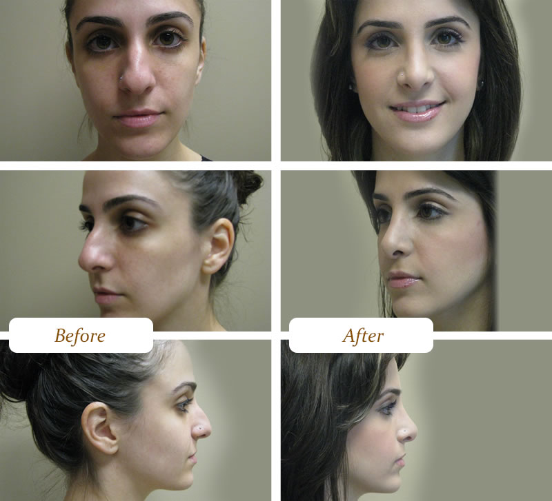 Rhinoplasty-Surgery