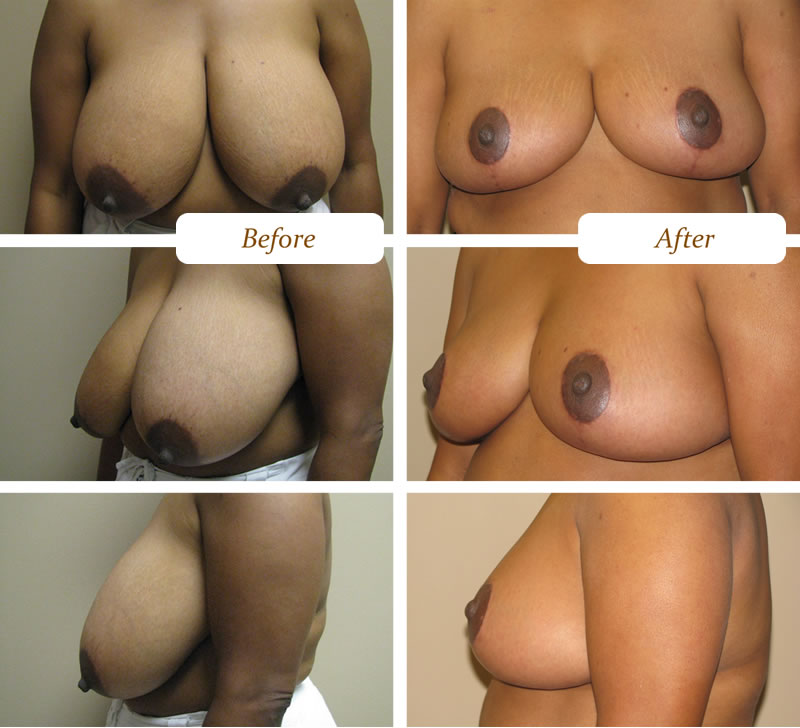breast-reduction-procedure