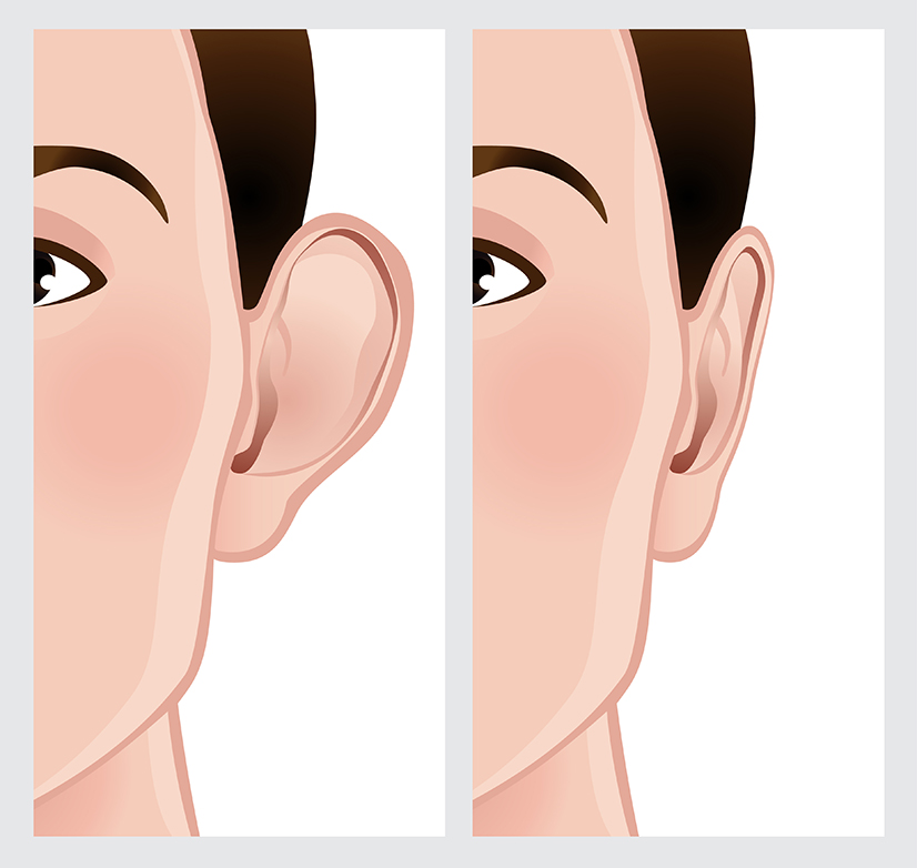 Ear Reshaping bigstock Ear Reshaping 50924888 sized