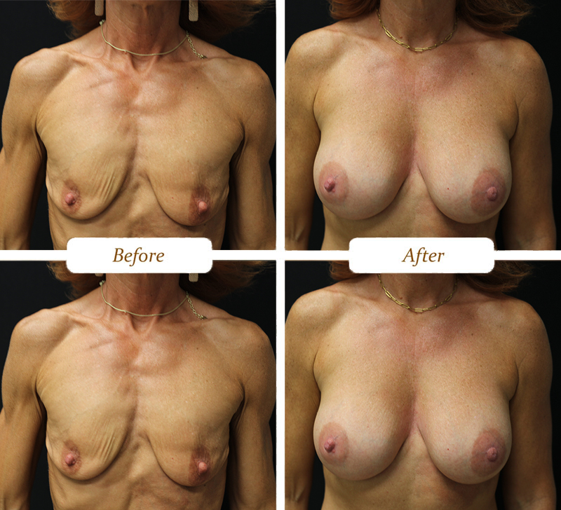 breast_aug_2025