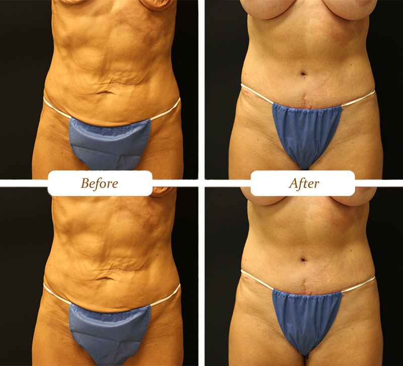 tummy_tuck_2025
