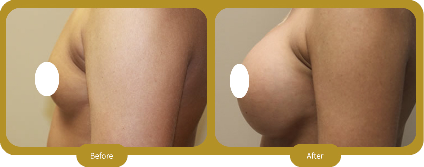 Breast